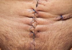 Correction de cicatrices : comment faire ?